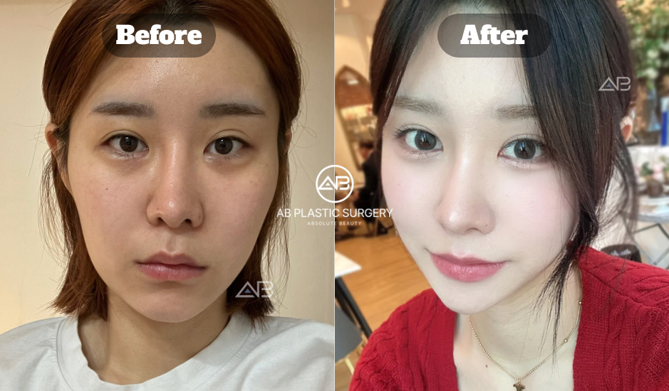 Ulasan sebelum dan sesudah revisi kelopak mata di Korea