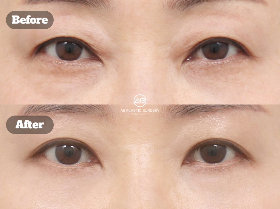 Review foto sebelum dan sesudah operasi kelopak mata bawah dan revisi operasi mata di Operasi Plastik AB Korea