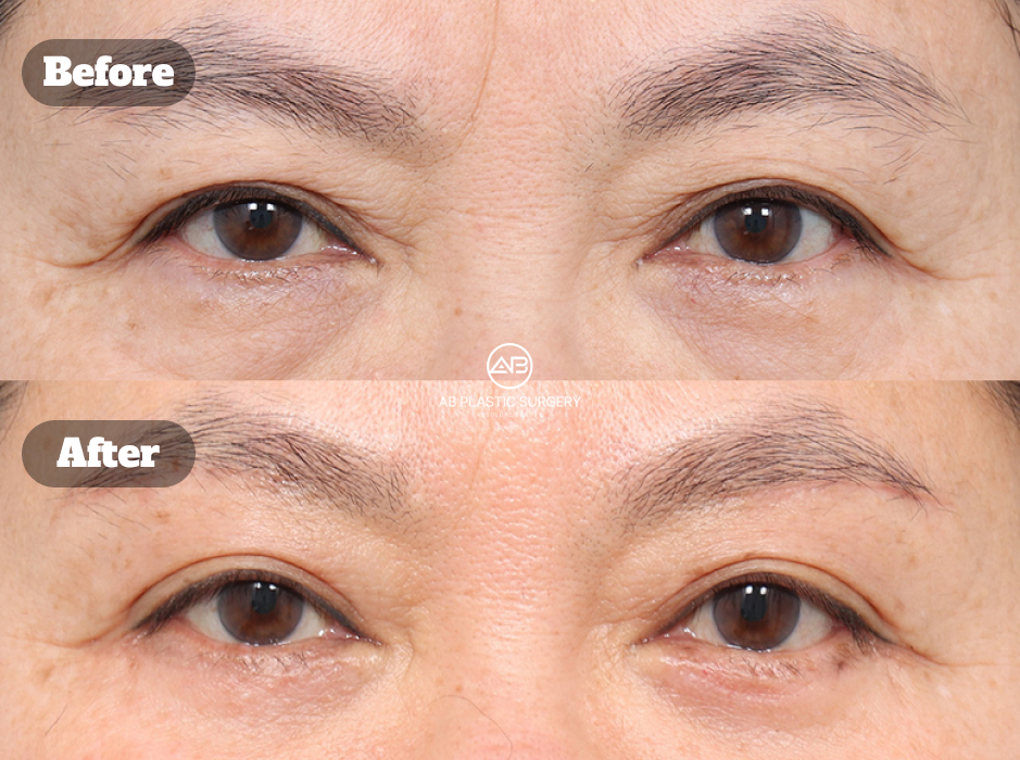 Foto sebelum dan sesudah operasi kelopak mata bawah di Operasi Plastik AB Korea
