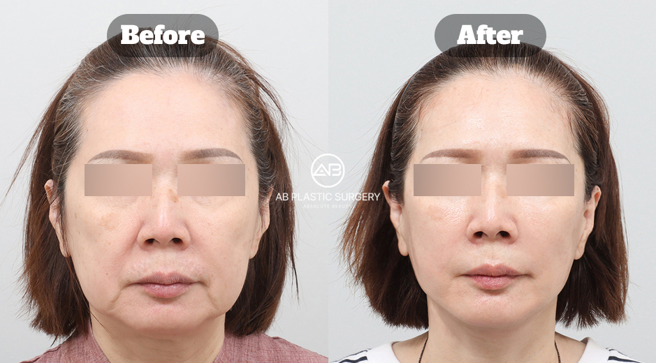 Before and after full face lifting, neck lifting, sedot lemak wajah double chin, dan fat grafting wajah di Korea oleh Operasi Plastik AB