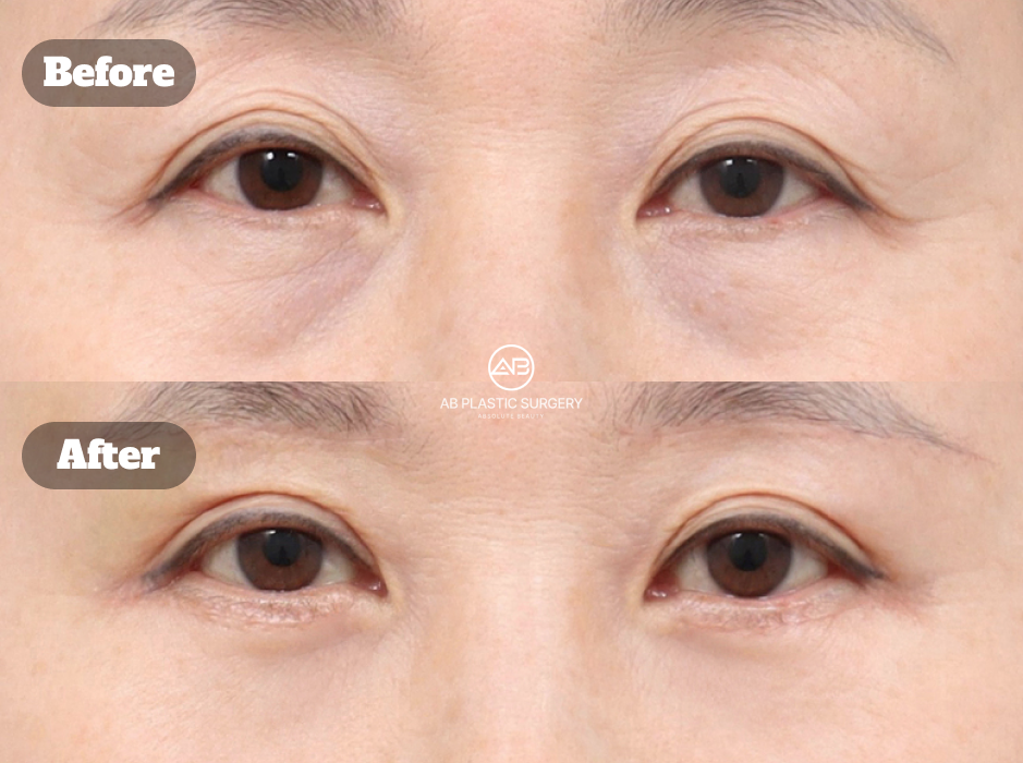 Foto sebelum dan sesudah upper eyelid lifting metode non-insisi revisi, eyebrow lift, dan operasi kelopak mata bawah di Korea
