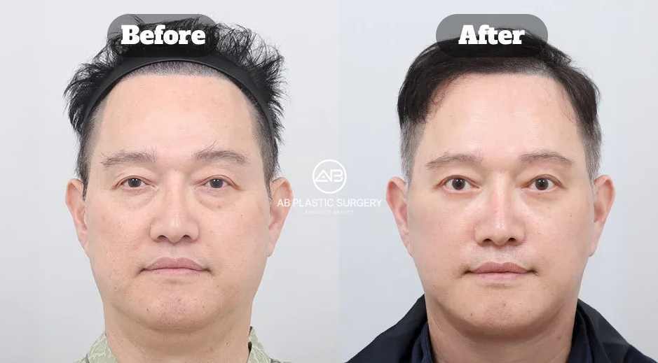 Foto sebelum dan sesudah full SMAS lifting, neck lifting, transplantasi lemak lipatan nasolabial, operasi kelopak mata bawah, dan eyebrow lift pada pria Korea