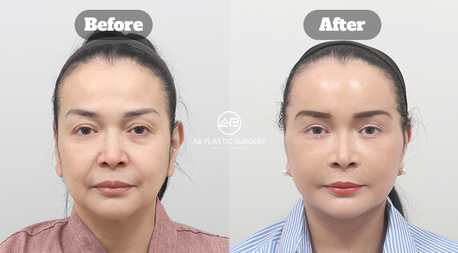 Perbandingan kondisi wajah dan leher sebelum dan sesudah prosedur full face lift dan neck lift