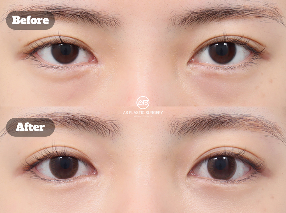 Before after under eye fat repositioning and fat grafting to reduce tired looking eyes