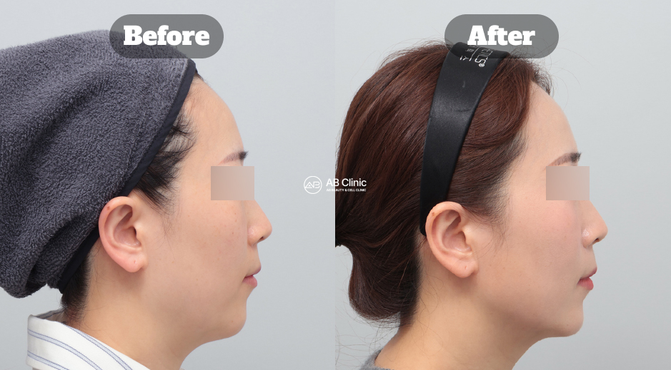 Perbandingan hasil sebelum dan sesudah Ultherapy di Korea untuk lifting dan pengencangan kulit wajah