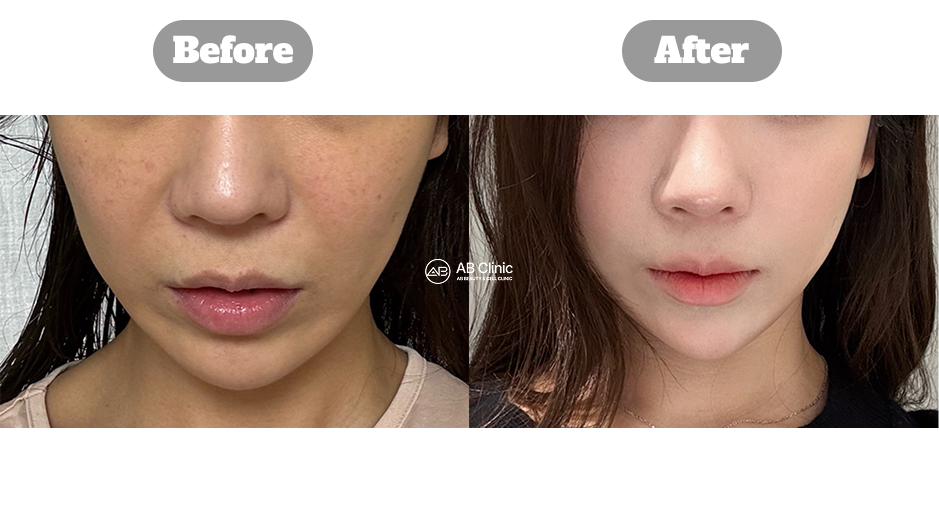 Perbandingan hasil sebelum dan sesudah Ultherapy 400 shots di Korea untuk memperbaiki kontur dan elastisitas kulit