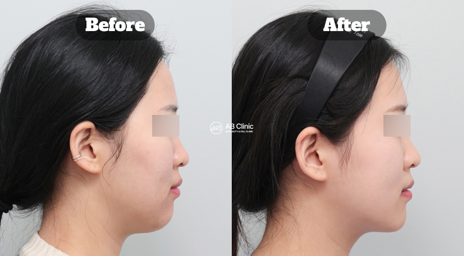 Perbandingan before after kombinasi Ultherapy dan Juvelook di Korea untuk pengencangan kulit dan tekstur wajah alami