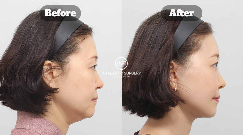 Perbandingan sebelum dan sesudah full SMAS lifting, forehead lifting, neck lifting, dan perawatan double chin di Korea