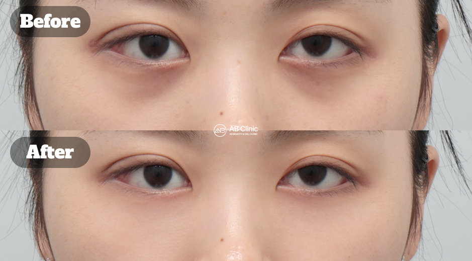 Before after skin booster treatment to improve skin hydration and texture