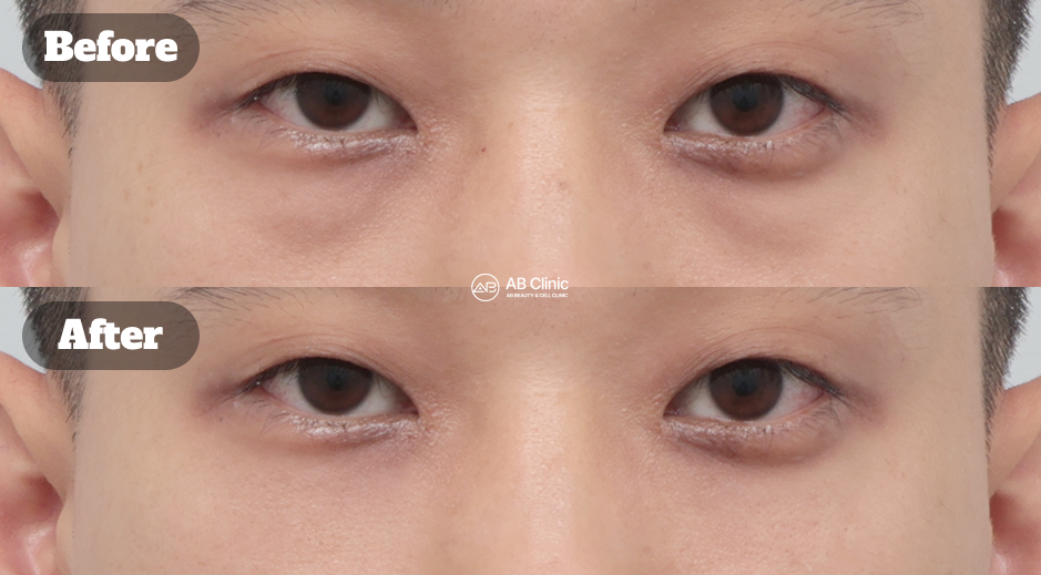 Before after male skin booster treatment to improve dark circles and tired looking eyes