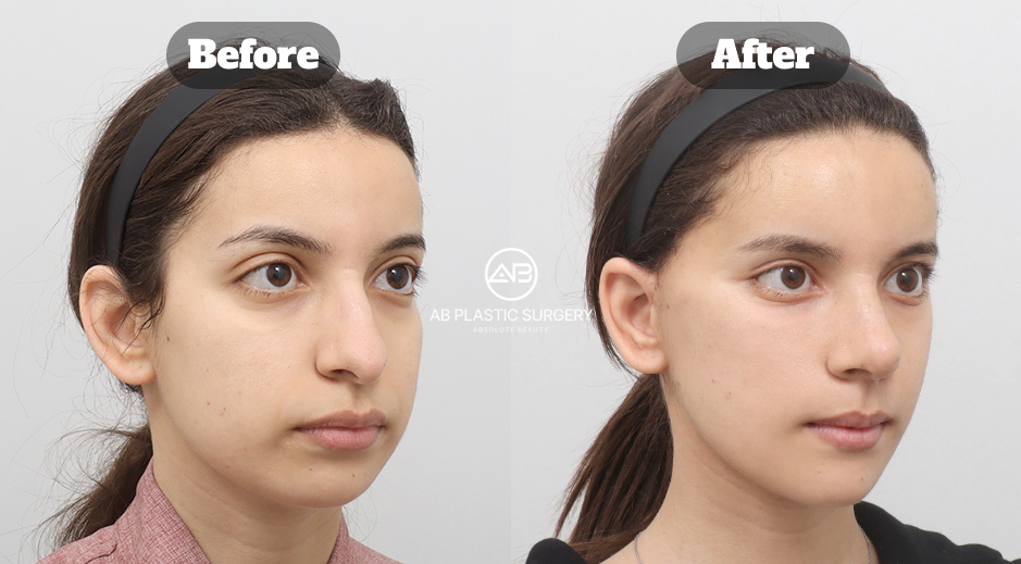 Perbandingan sebelum dan sesudah ponytail lifting dan pengangkatan lemak pipi di Korea