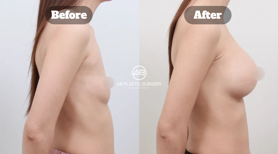 Perbandingan Payudara Turun Sebelum Dan Sesudah Operasi Payudara Mentor Di Korea