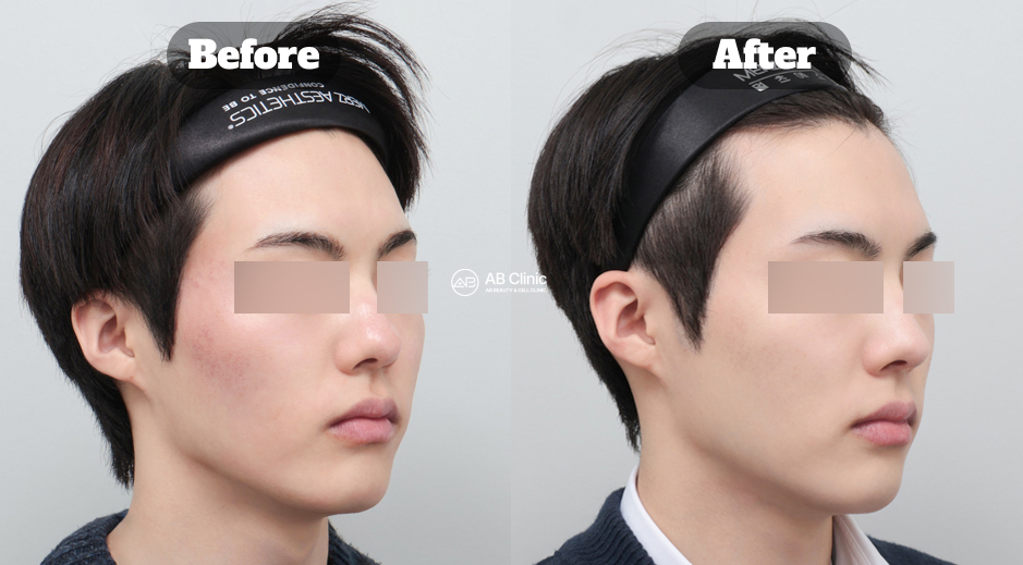 Perbandingan sebelum dan sesudah perawatan Potenza skin booster pria di Korea untuk memperbaiki tekstur kulit wajah