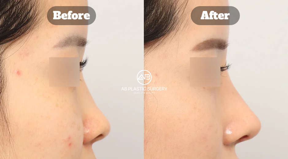 Hasil perubahan hidung pesek setelah operasi hidung Korea dengan garis hidung lebih natural