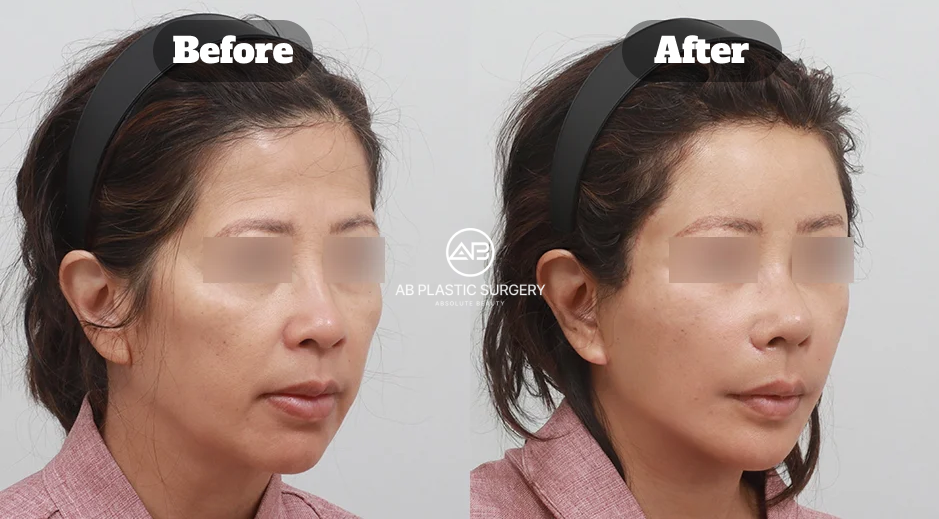 Perbandingan sebelum dan sesudah full SMAS facelift dan endotine forehead lift di AB Plastic Surgery Korea untuk pipi turun