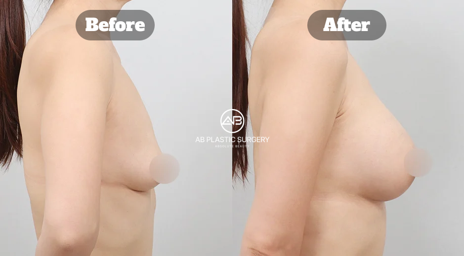 Perbandingan Payudara Turun Sebelum Dan Sesudah Operasi Implan Mentor Korea