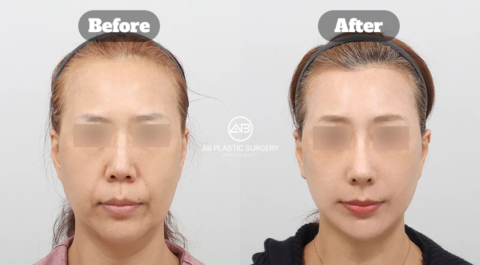 Perbandingan sebelum dan sesudah full SMAS facelift dan forehead lift di AB Plastic Surgery Korea untuk mengatasi pipi turun
