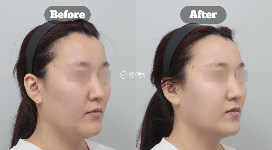 Perbandingan sebelum dan sesudah perawatan Potenza dan Lesnov Crystal di Korea yang membantu meratakan warna kulit dan menciptakan glass skin