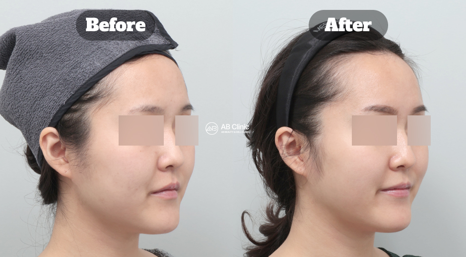 Foto sebelum dan sesudah perawatan Potenza dan Lesnov Crystal di Korea yang membantu meningkatkan kecerahan kulit dan efek glass skin