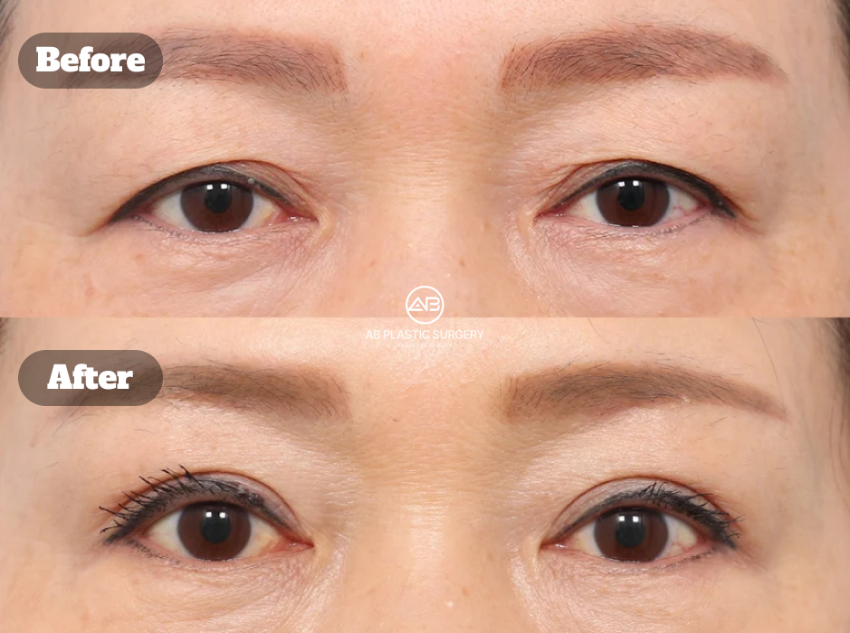 perbandingan sebelum dan sesudah operasi kelopak mata turun dengan koreksi ptosis dan lifting dahi endoskopik di Korea