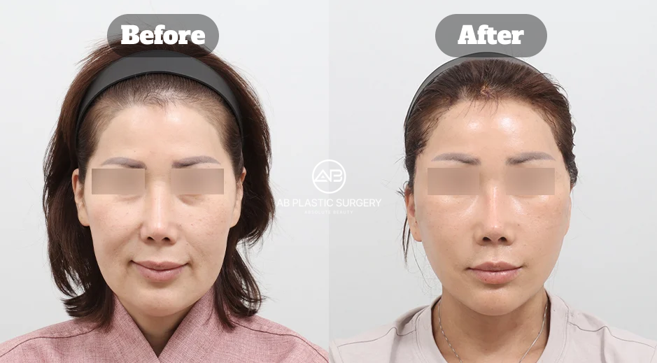 Perbandingan before after full SMAS facelift di AB Plastic Surgery Korea untuk kasus pipi turun dan smile line dalam