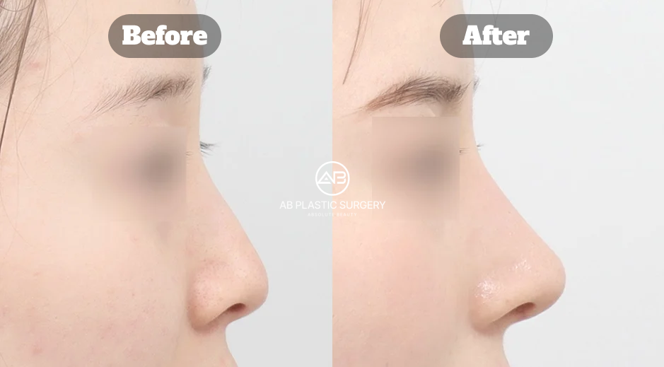 Perubahan struktur hidung pesek setelah operasi hidung Korea pada pasien Asia