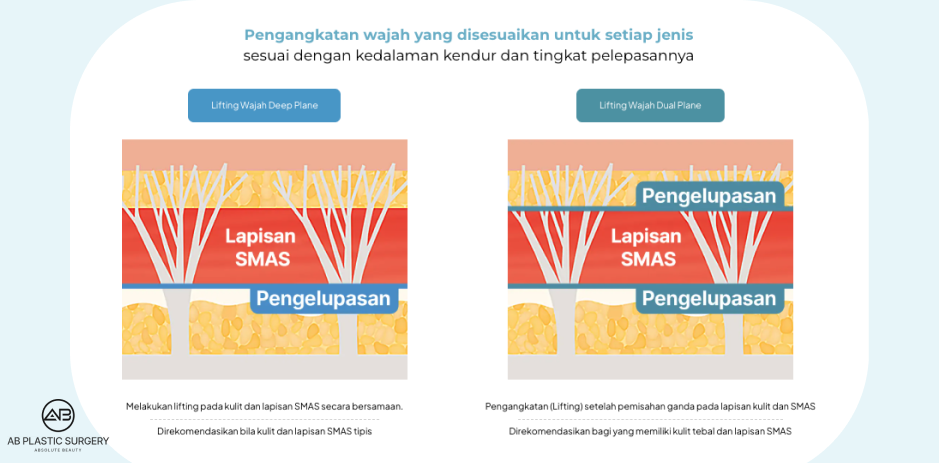 Diagram perbandingan teknik Deep Plane dan Dual Plane pada SMAS facelift di Korea untuk mengatasi pipi turun dan kulit kendur