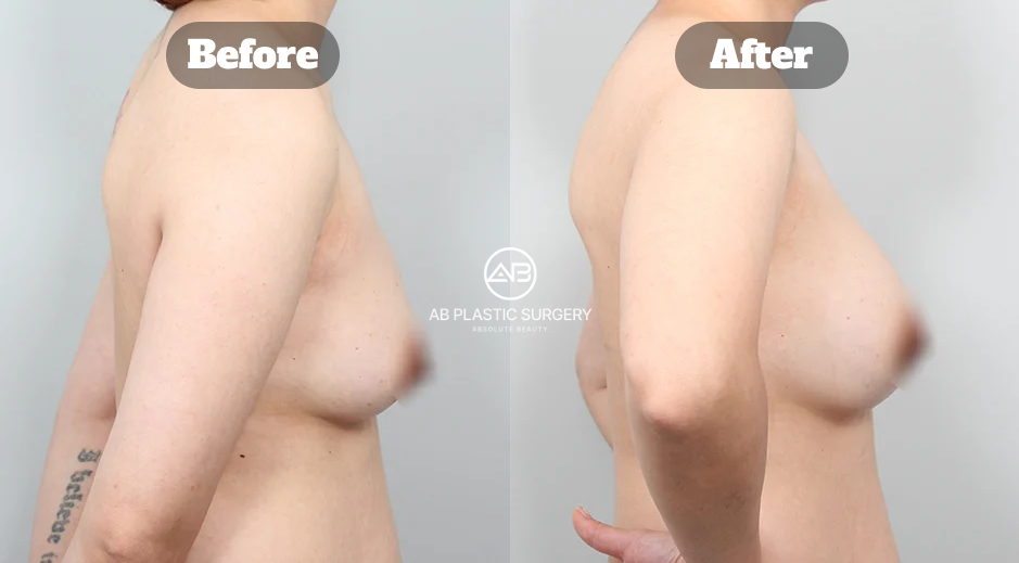 Perbandingan Sebelum Dan Sesudah Operasi Payudara Turun Dengan Teknik Breast Lift Motiva Di Korea