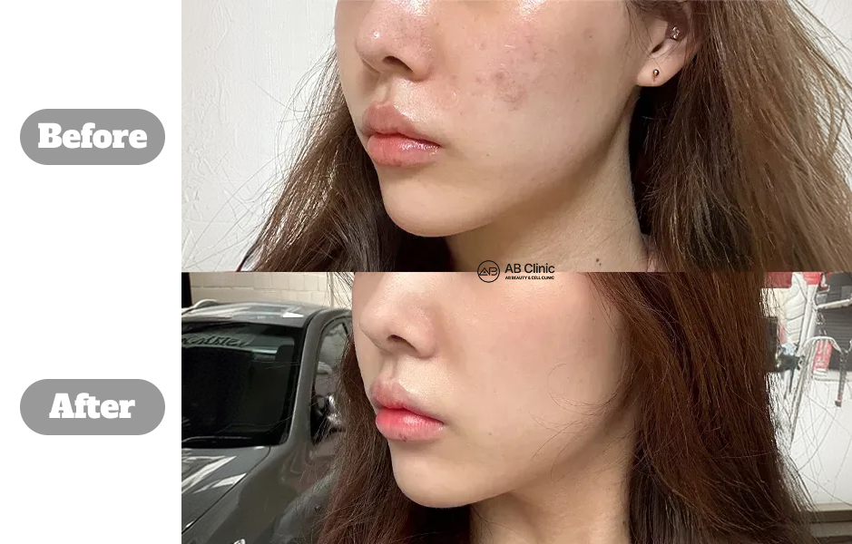 Perbandingan sebelum dan sesudah perawatan Rejuran skin booster di Korea untuk memperbaiki tekstur kulit