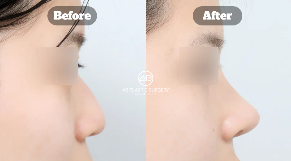 Contoh hasil operasi hidung Korea untuk hidung pesek dengan struktur hidung lebih seimbang