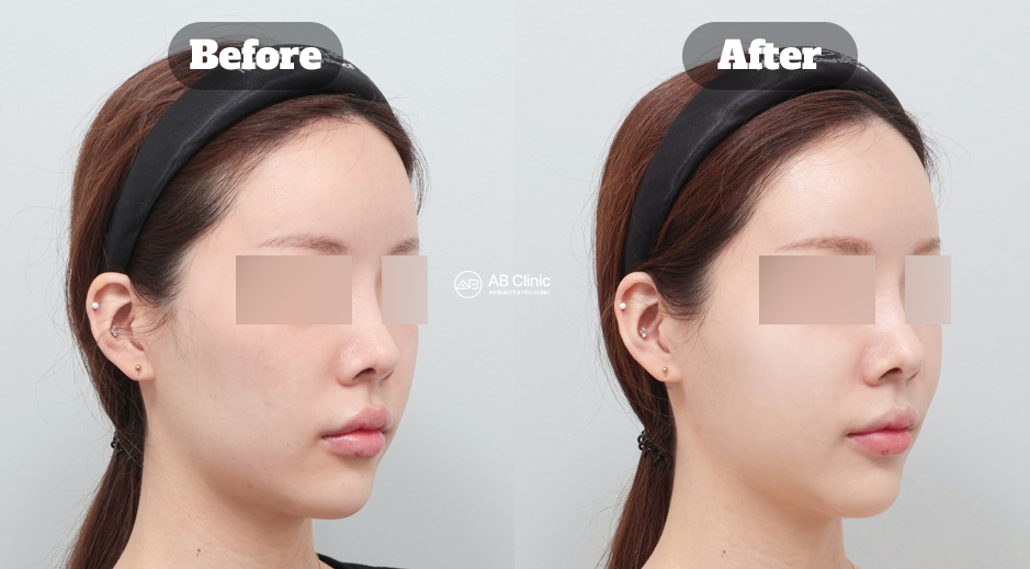 Perbandingan sebelum dan sesudah perawatan Rejuran Healer di Korea yang membantu meningkatkan hidrasi dan kualitas kulit