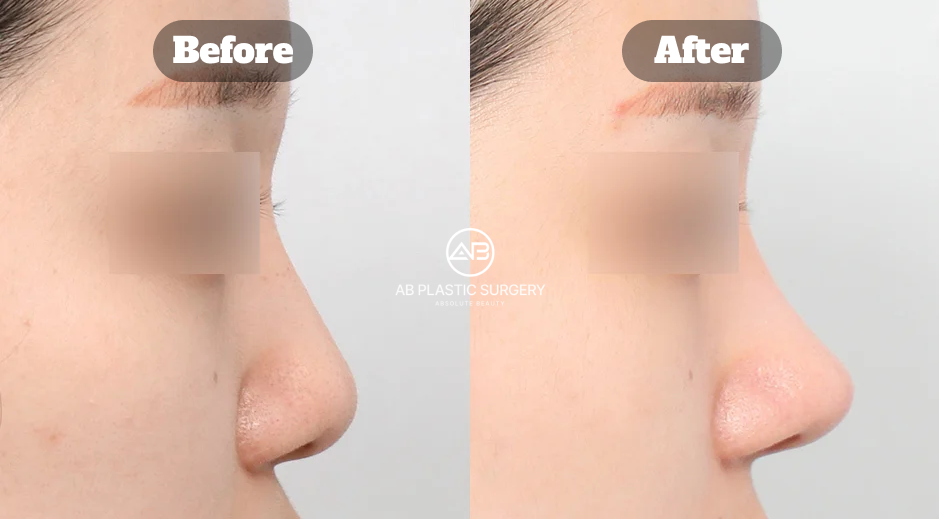 Perubahan hidung pesek pada pasien pria setelah operasi hidung Korea