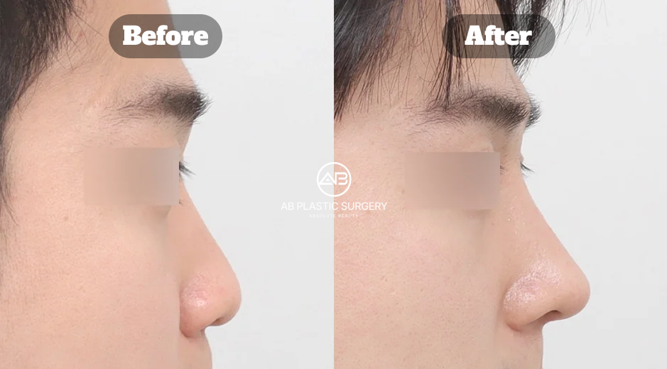 Contoh koreksi hidung pesek pada pria melalui operasi hidung Korea