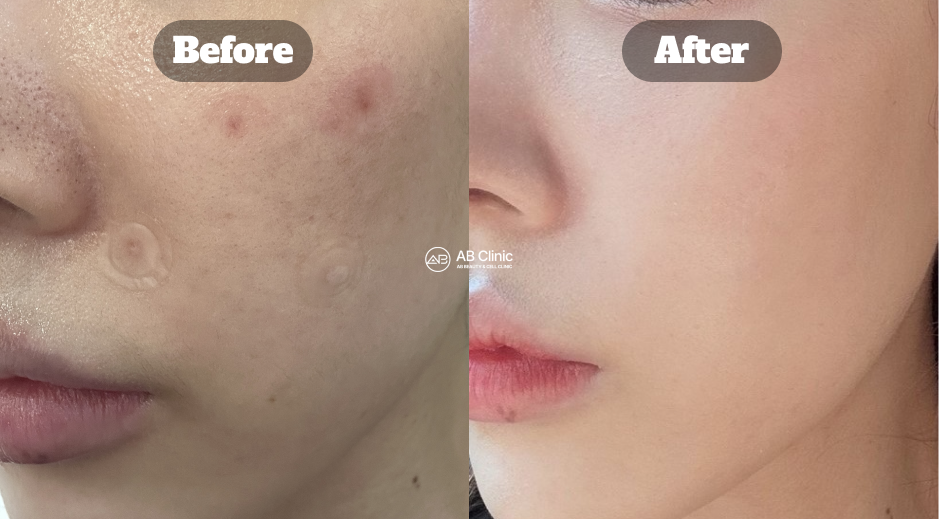 Foto sebelum dan sesudah perawatan skin booster Rejuran di Korea yang membantu memperbaiki bekas jerawat dan tekstur kulit