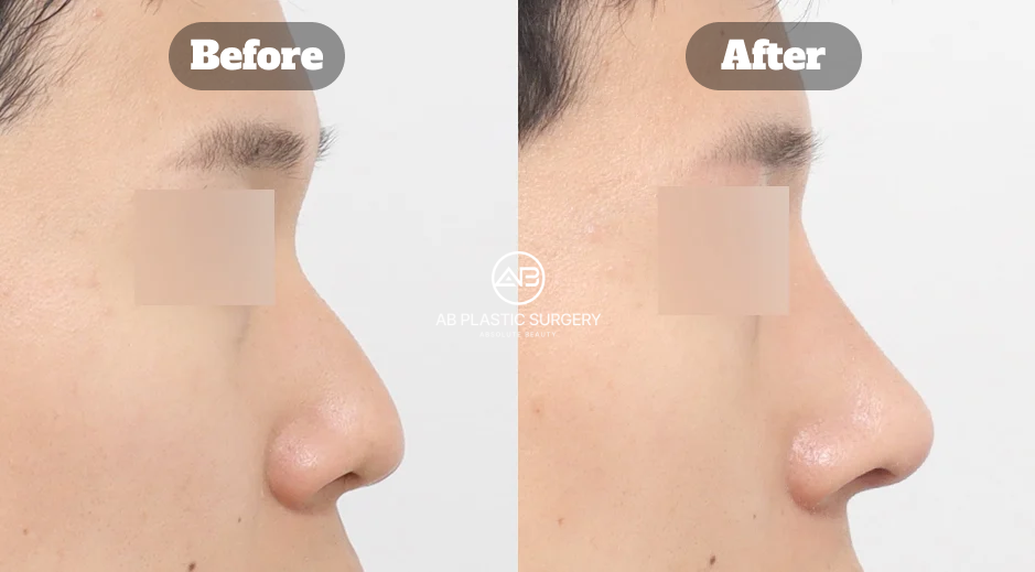 Hasil koreksi hidung pesek pada pria menggunakan operasi hidung Korea