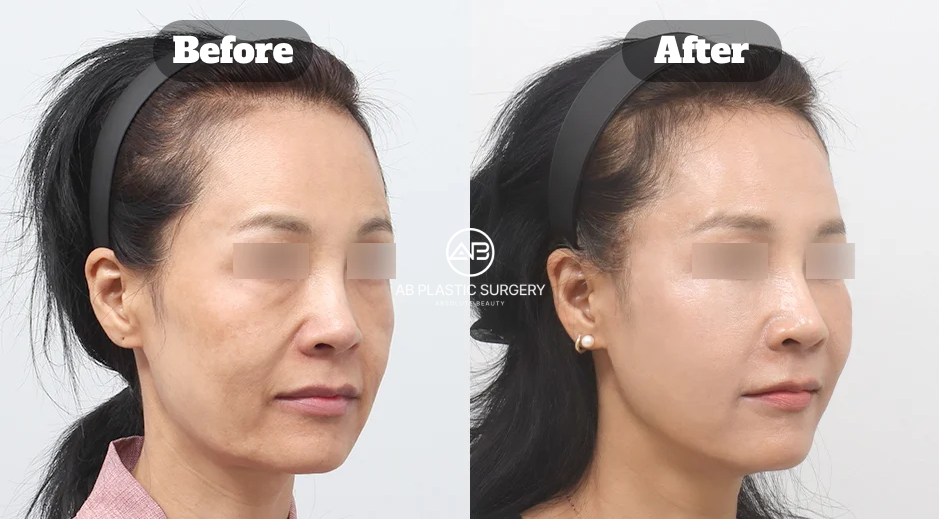 Perbandingan sebelum dan sesudah mint thread lifting di AB Plastic Surgery Korea untuk mengatasi kulit kendur dan garis senyum
