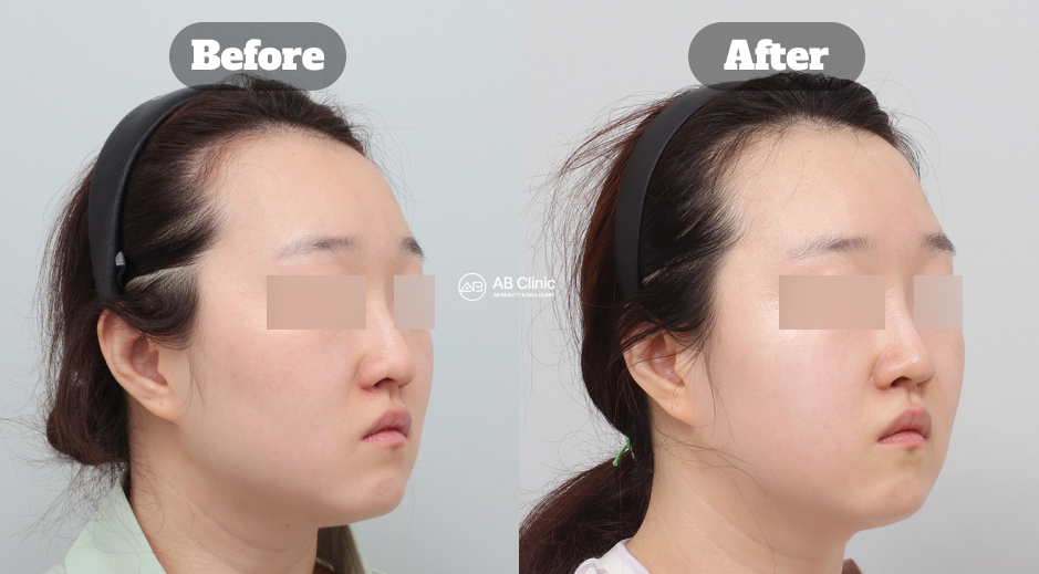 Perbandingan sebelum dan sesudah perawatan Rejuran Healer di Korea yang membantu menciptakan efek glass skin alami