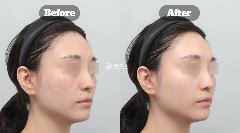 Perbandingan sebelum dan sesudah perawatan Ellavie Retuo skin booster di Korea untuk meningkatkan kualitas kulit wajah