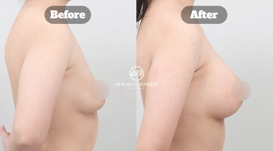 Perubahan Profil Payudara Turun Setelah Operasi Payudara Mentor Di Korea