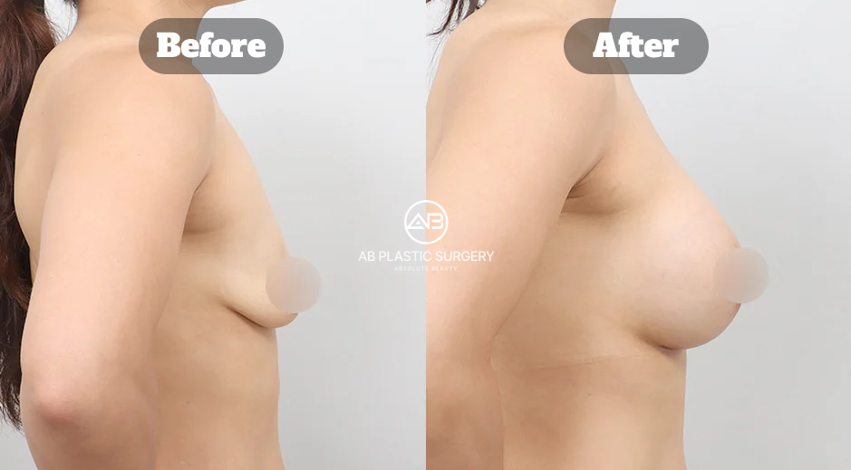 Perbandingan Bentuk Payudara Turun Sebelum Dan Sesudah Operasi Implan Mentor Di Korea
