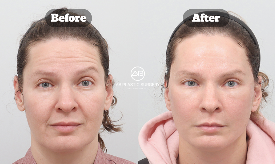 Perbandingan sebelum dan sesudah SMAS facelift di AB Plastic Surgery Korea untuk mengatasi pipi turun dan smile line dalam