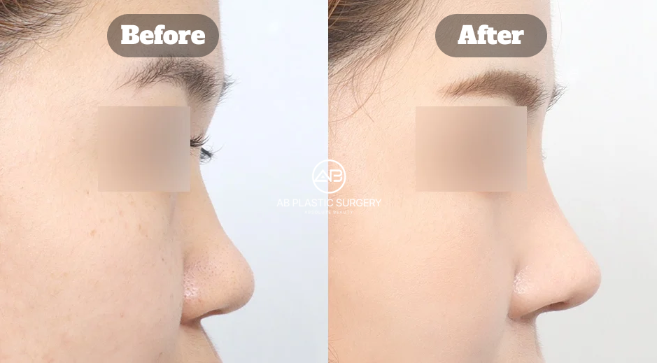 Perubahan bentuk hidung pesek setelah operasi hidung Korea dengan profil hidung lebih seimbang