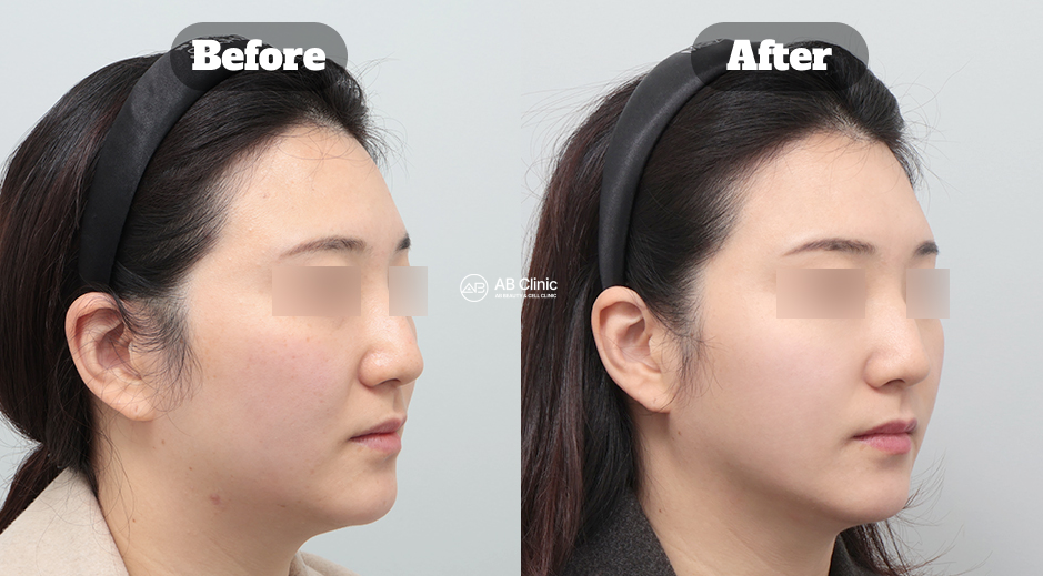 Perbandingan sebelum dan sesudah perawatan stem cell skin booster di Korea untuk meningkatkan elastisitas dan efek glass skin