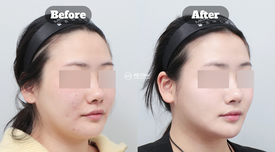 hasil sebelum dan sesudah perawatan wajah di Korea dengan kombinasi Ulthera, Thermage, dan Rejuran untuk peremajaan kulit, meningkatkan elastisitas, dan membuat wajah tampak lebih muda alami