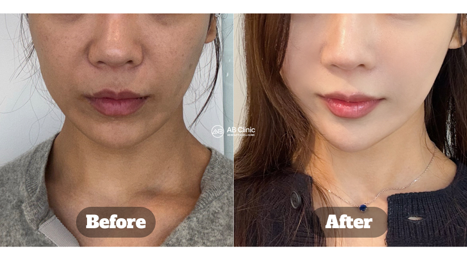 hasil sebelum dan sesudah perawatan wajah di Korea dengan Ulthera untuk mengencangkan area wajah dan leher, mengurangi kendur, dan memberikan tampilan lebih tegas alami