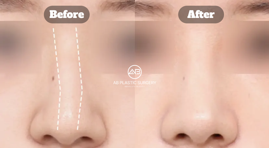 Perbandingan sebelum dan sesudah koreksi hidung bengkok di Operasi Plastik AB Korea dengan hasil simetris dan alami