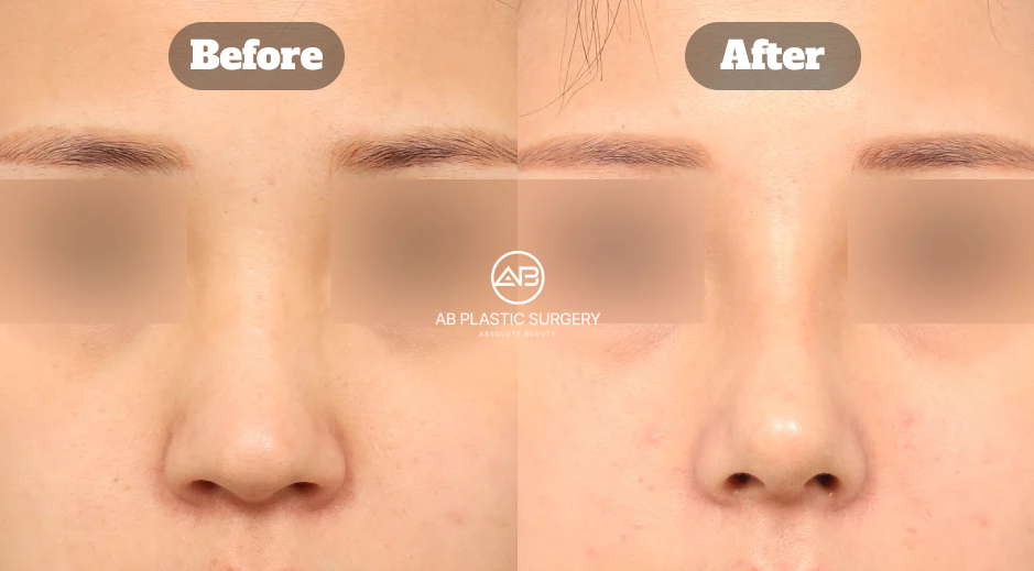 Hasil sebelum dan sesudah operasi hidung bengkok dengan koreksi hidung bungkuk dan hidung bulbous di Operasi Plastik AB Korea