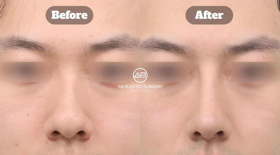 Transformasi sebelum dan sesudah hidung bengkok melalui rhinoplasty kompleks dengan koreksi hump, bulbous, dan alar reduction di Operasi Plastik AB Korea