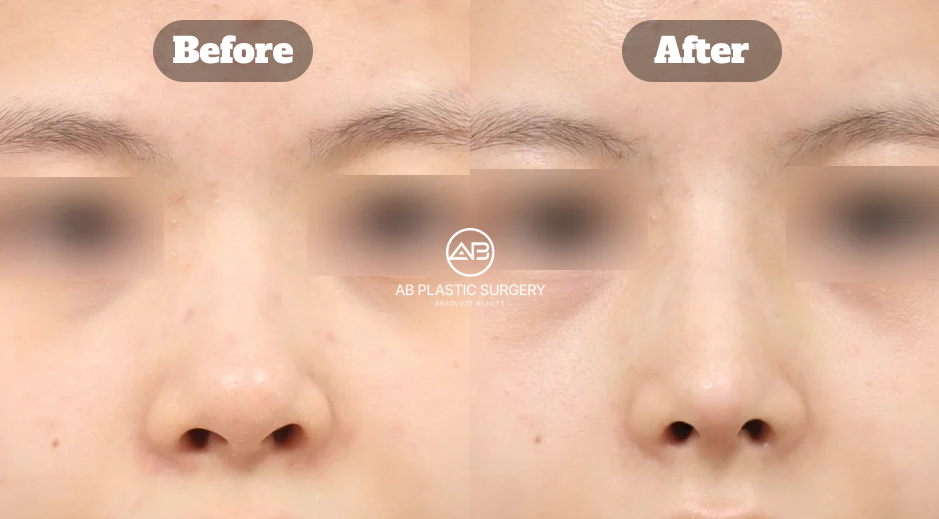 Perubahan hidung bengkok melalui rhinoplasty tanpa implan dengan osteotomy dan koreksi fungsi di Operasi Plastik AB Korea sebelum dan sesudah