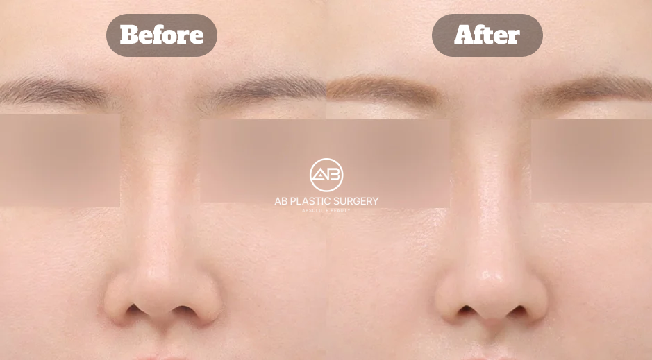 Hasil revisi hidung bengkok dengan perbaikan hidung pendek menggunakan tulang rawan sendiri dan koreksi fungsi di Operasi Plastik AB Korea